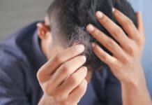 10 Things You Need to Know about Alopecia