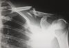 3 indications you might claim the case for a personal injury human X-ray result chart