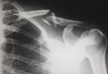 3 indications you might claim the case for a personal injury human X-ray result chart