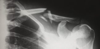 3 indications you might claim the case for a personal injury human X-ray result chart