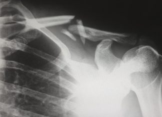 3 indications you might claim the case for a personal injury human X-ray result chart