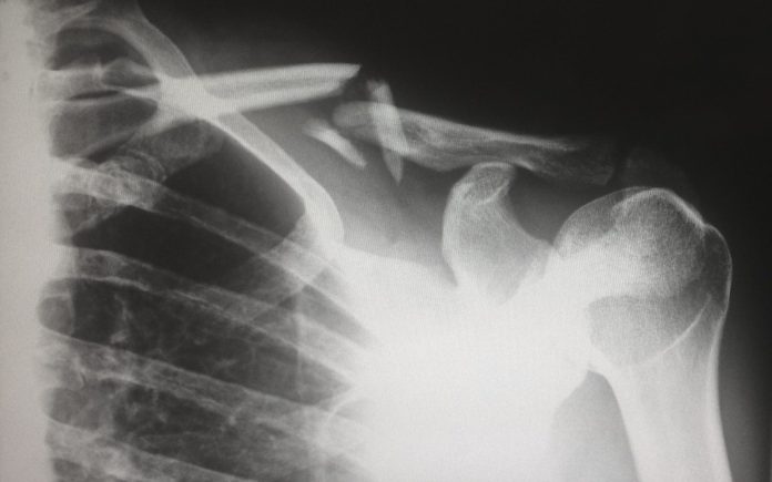 Photo by Harlie Raethel human X-ray result chart