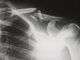 3 indications you might claim the case for a personal injury human X-ray result chart
